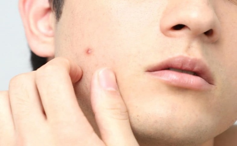 Pimple on Face Image Hum Dekhenge