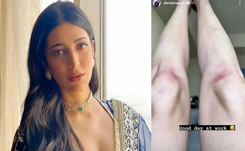 Shruti Haasan Got Injured