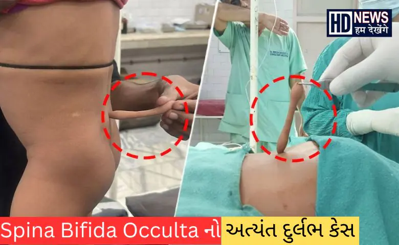 spina bifida